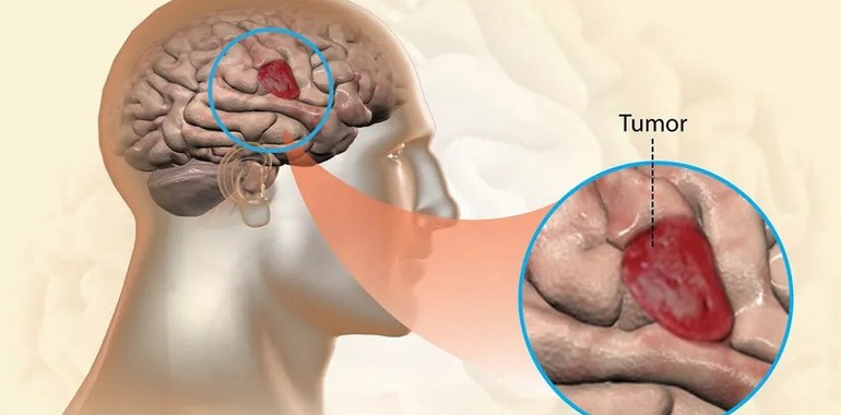 Gliablastoma Tipi Beyin Kanseri, Düşüncelerinizden Besleniyor Olabilir!